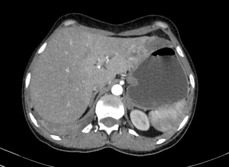 File:Cannonball metastases from breast cancer (Radiopaedia 91024-108569 A 114).jpg