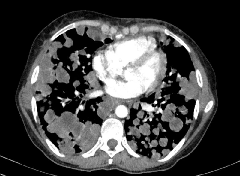 File:Cannonball metastases from breast cancer (Radiopaedia 91024-108569 A 76).jpg