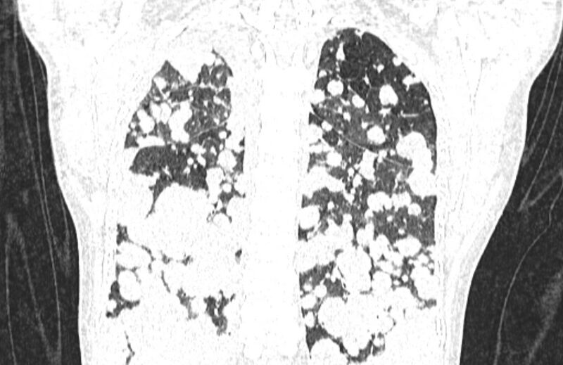File:Cannonball metastases from breast cancer (Radiopaedia 91024-108569 Coronal lung window 111).jpg
