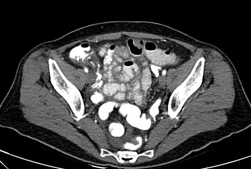 File:Carcinoid mesenteric tumor complicated by chylous ascites (Radiopaedia 76312-88926 A 62).jpg