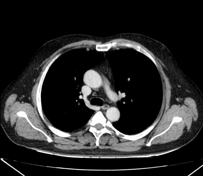 File:Carcinoid tumor with hepatic metastases (Radiopaedia 22651-22670 C 12).jpg