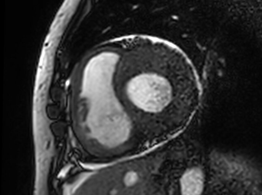 Cardiac amyloidosis (Radiopaedia 61600-69579 Short axis bSSFP 253).jpg