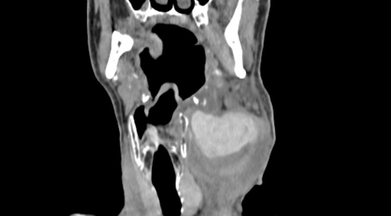 File:Carotid artery pseudoaneurysm (Radiopaedia 84030-99259 D 33).jpg