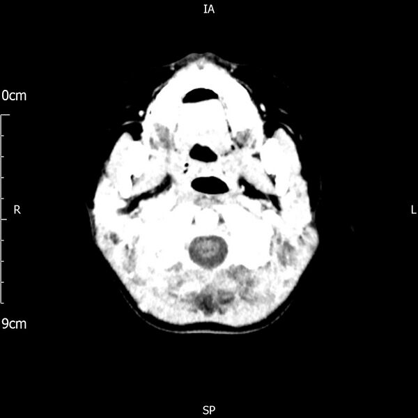 File:Cavernous sinus thrombosis (Radiopaedia 79414-92510 Axial Brain 39).jpg