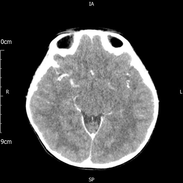 File:Cavernous sinus thrombosis (Radiopaedia 79414-92510 Axial Brain 96).jpg