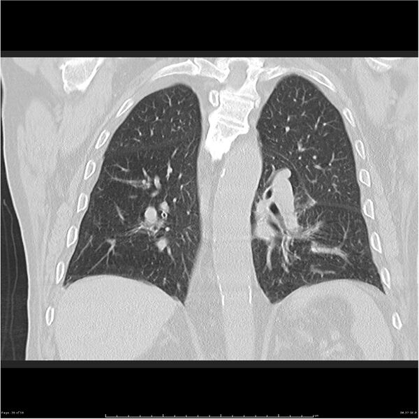 File:Cavitating left lower lobe lesion - squamous cell lung cancer (Radiopaedia 27749-28176 Coronal lung window 36).jpg