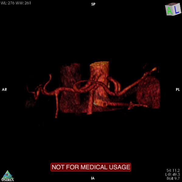 File:Celiac trunk variant anatomy - gastrohepatic trunk and splenic artery (Radiopaedia 38815-40995 B 19).jpg