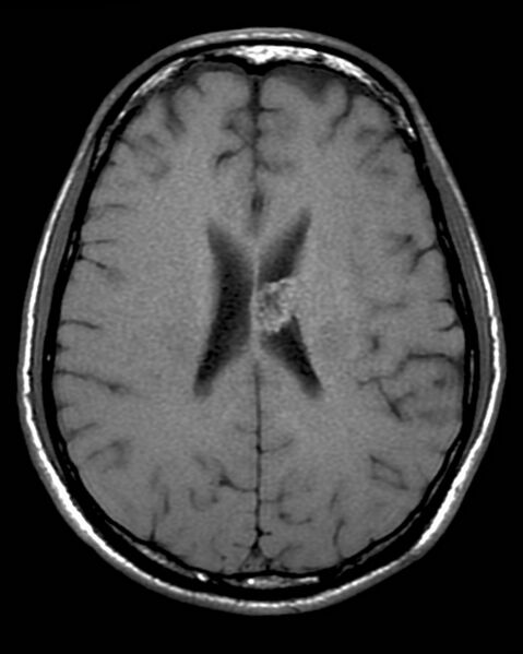 File:Central neurocytoma (Radiopaedia 2590-6285 Axial T1 1).jpg