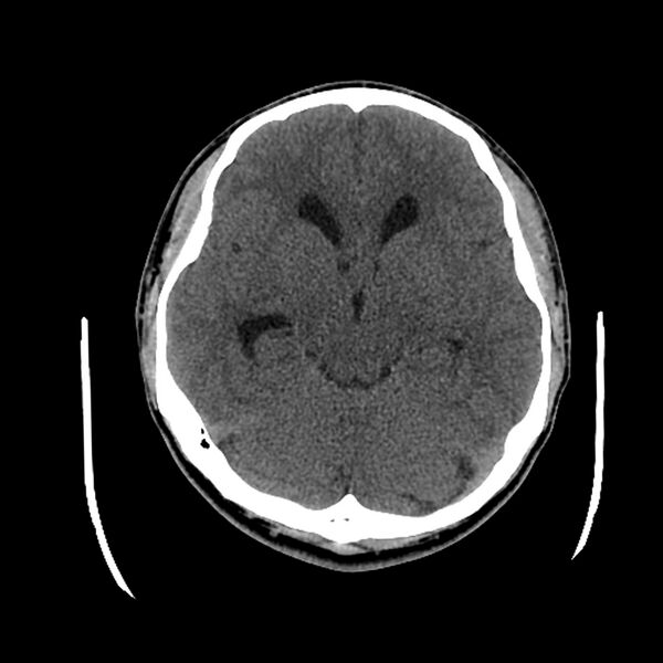 File:Central neurocytoma (Radiopaedia 79320-92379 Axial non-contrast 21).jpg