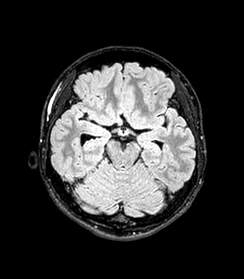 Central neurocytoma (Radiopaedia 79320-92380 Axial FLAIR 197).jpg