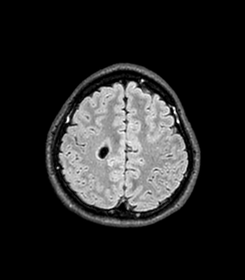 Central neurocytoma (Radiopaedia 79320-92380 Axial FLAIR 83).jpg