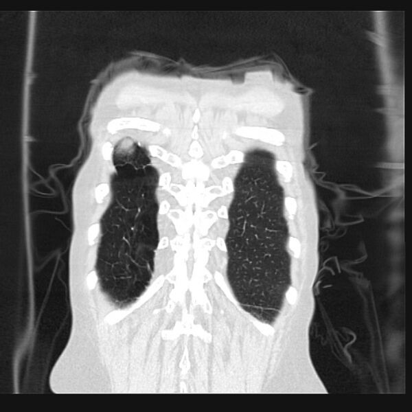 File:Centrilobular pulmonary emphysema (Radiopaedia 24495-24789 Coronal lung window 70).jpg