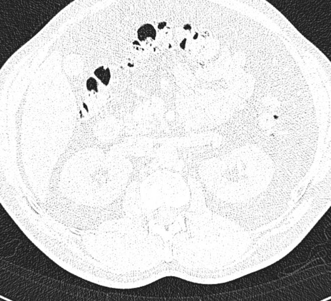 File:Centrilobular pulmonary emphysema (Radiopaedia 26808-26971 Axial lung window 46).jpg