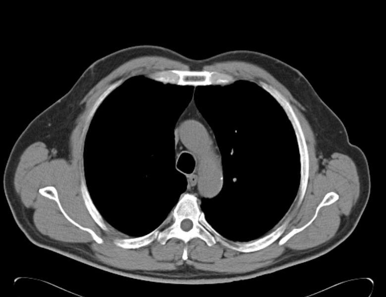 File:Centrilobular pulmonary emphysema (Radiopaedia 26808-26971 Axial non-contrast 13).jpg