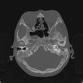 Cerebellar abscess secondary to mastoiditis (Radiopaedia 26284-26413 Axial bone window 45).jpg