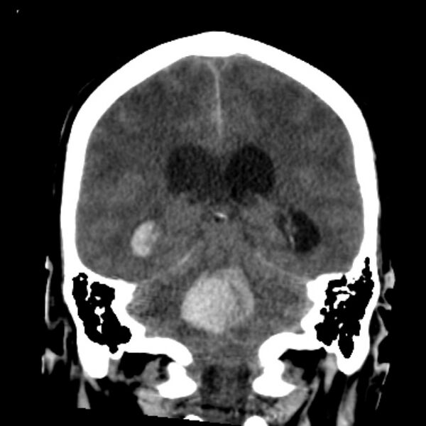 File:Cerebellar hemorrhage causing obstructive hydrocephalus (Radiopaedia 33989-35207 Coronal non-contrast 35).jpg