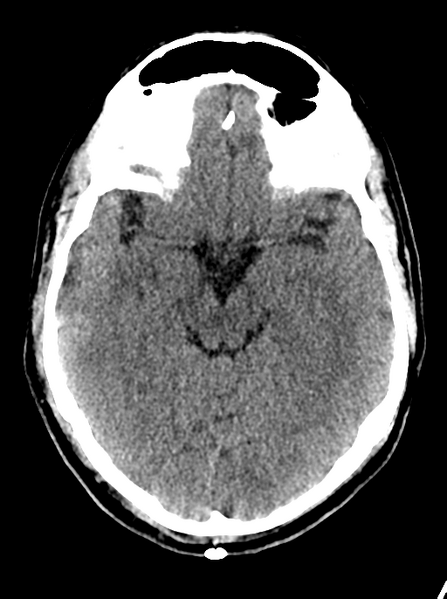 File:Cerebellar infarct due to vertebral artery dissection with posterior fossa decompression (Radiopaedia 82779-97032 Axial non-contrast 11).png