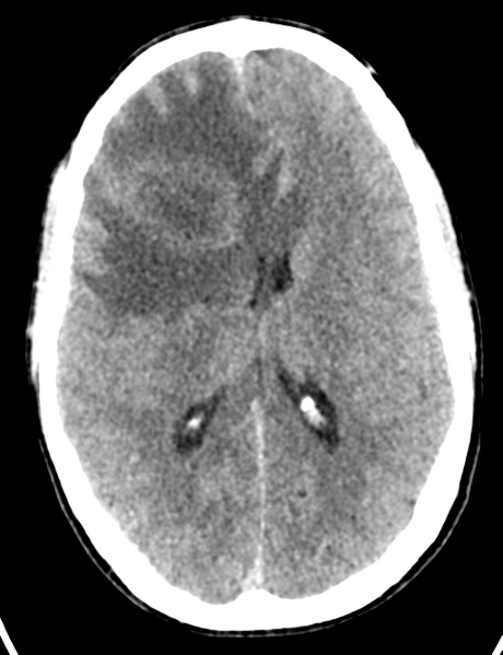 File:Cerebral abscess (Radiopaedia 60342-68008 Axial non-contrast 30).png