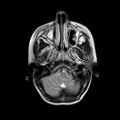 Cerebral abscess post cardiac surgery (Radiopaedia 27244-27420 Axial T2 3).jpg