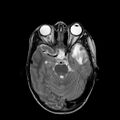 Cerebral abscess post cardiac surgery (Radiopaedia 27244-27420 Axial T2 8).jpg
