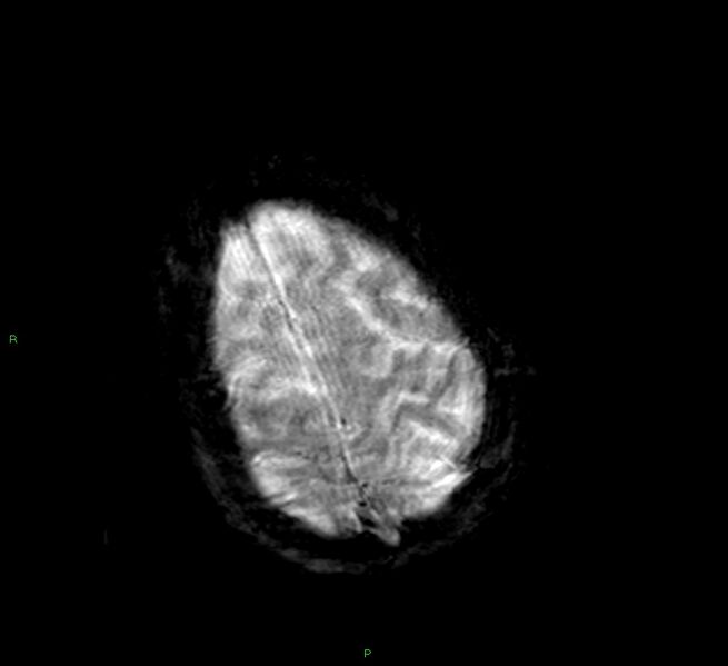 File:Cerebral amyloid angiopathy-associated lobar intracerebral hemorrhage (Radiopaedia 58377-65515 Axial Gradient Echo 6).jpg