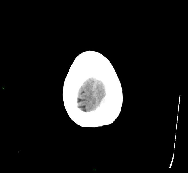 File:Cerebral amyloid angiopathy-associated lobar intracerebral hemorrhage (Radiopaedia 58529-65681 Axial non-contrast 5).jpg