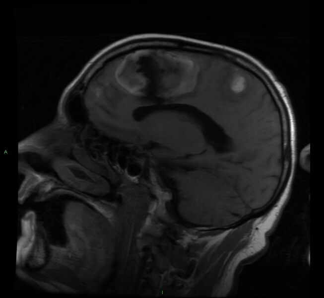 File:Cerebral amyloid angiopathy-associated lobar intracerebral hemorrhage (Radiopaedia 58529-65684 Sagittal T1 14).jpg