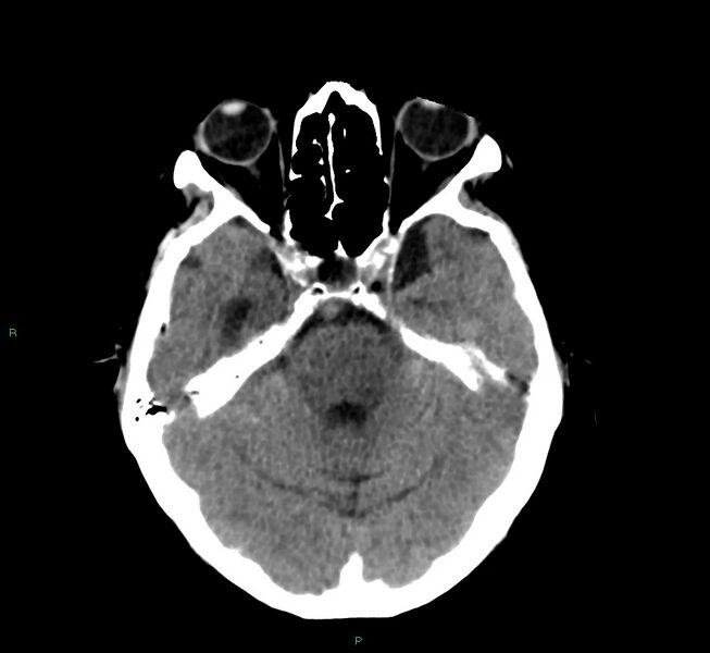File:Cerebral amyloid angiopathy-associated lobar intracerebral hemorrhage (Radiopaedia 58530-65688 Axial non-contrast 35).jpg