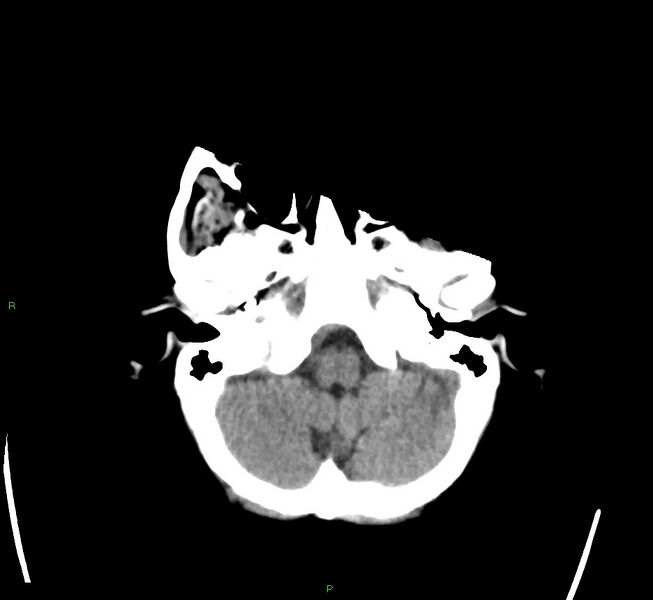 File:Cerebral amyloid angiopathy-associated lobar intracerebral hemorrhage (Radiopaedia 58563-65727 Axial non-contrast 45).jpg