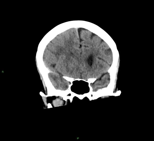 File:Cerebral amyloid angiopathy-associated lobar intracerebral hemorrhage (Radiopaedia 58563-65727 Coronal non-contrast 45).jpg