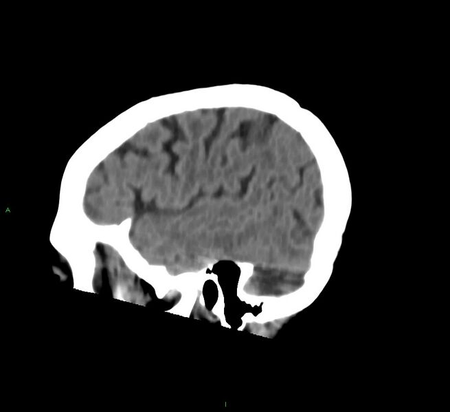 File:Cerebral amyloid angiopathy-associated lobar intracerebral hemorrhage (Radiopaedia 58757-65978 C 12).jpg