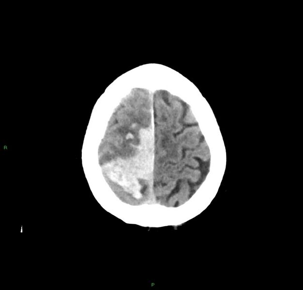 File:Cerebral amyloid angiopathy-associated lobar intracerebral hemorrhage (Radiopaedia 59356-66716 Axial non-contrast 8).jpg