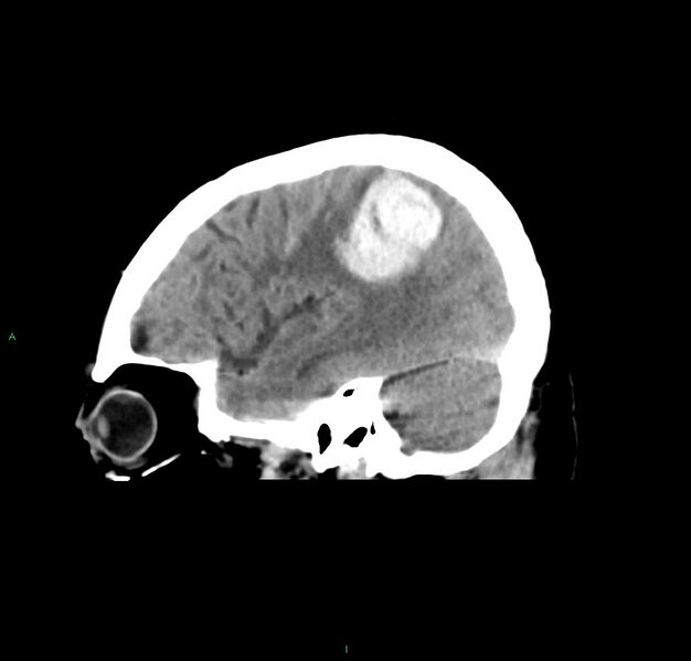 File:Cerebral amyloid angiopathy-associated lobar intracerebral hemorrhage (Radiopaedia 59356-66716 C 16).jpg