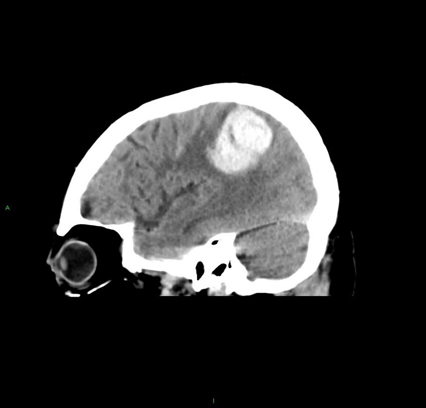 Cerebral amyloid angiopathy-associated lobar intracerebral hemorrhage (Radiopaedia 59356-66716 C 16).jpg