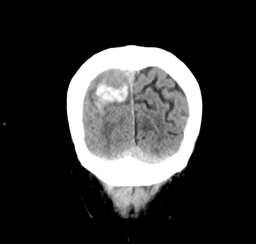 Cerebral amyloid angiopathy-associated lobar intracerebral hemorrhage (Radiopaedia 59356-66716 Coronal non-contrast 11).jpg