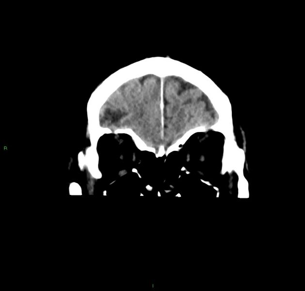 File:Cerebral amyloid angiopathy-associated lobar intracerebral hemorrhage (Radiopaedia 59356-66716 Coronal non-contrast 54).jpg