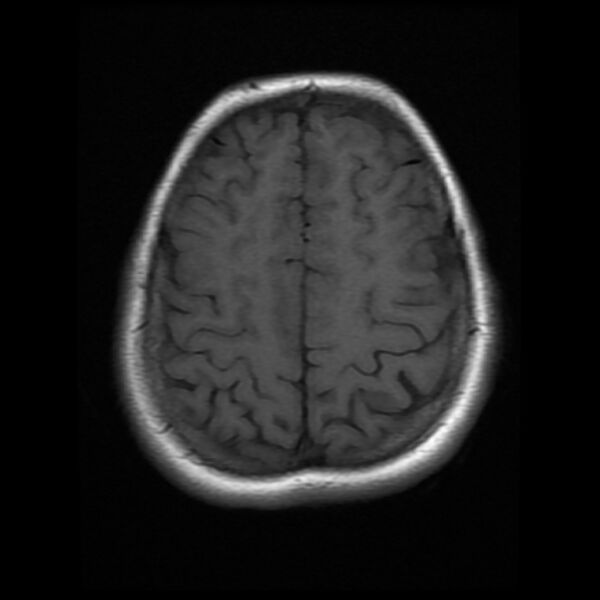 File:Cerebral cavernous malformation (Radiopaedia 44301-47942 Axial T1 17).jpg