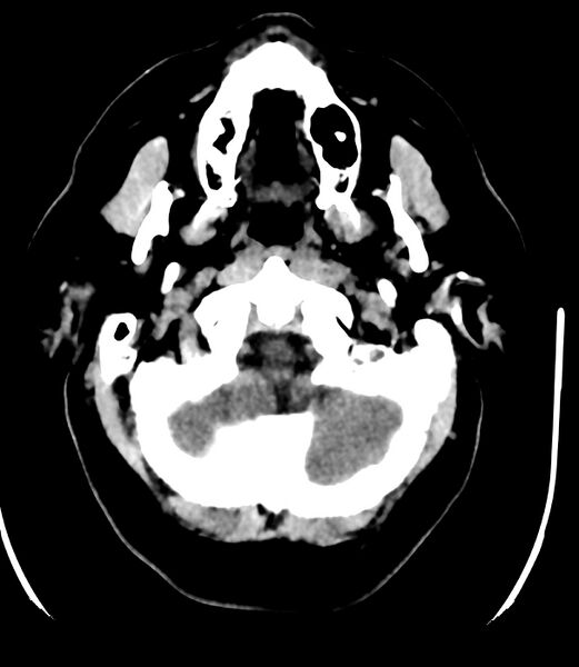 File:Cerebral dural venous sinus thrombosis (Radiopaedia 86514-102575 Axial non-contrast 5).jpg