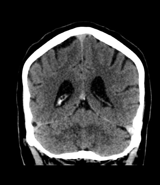 File:Cerebral dural venous sinus thrombosis (Radiopaedia 86514-102575 Coronal non-contrast 36).jpg