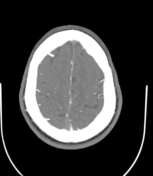 File:Cerebral dural venous sinus thrombosis (Radiopaedia 86514-102576 A 79).jpg