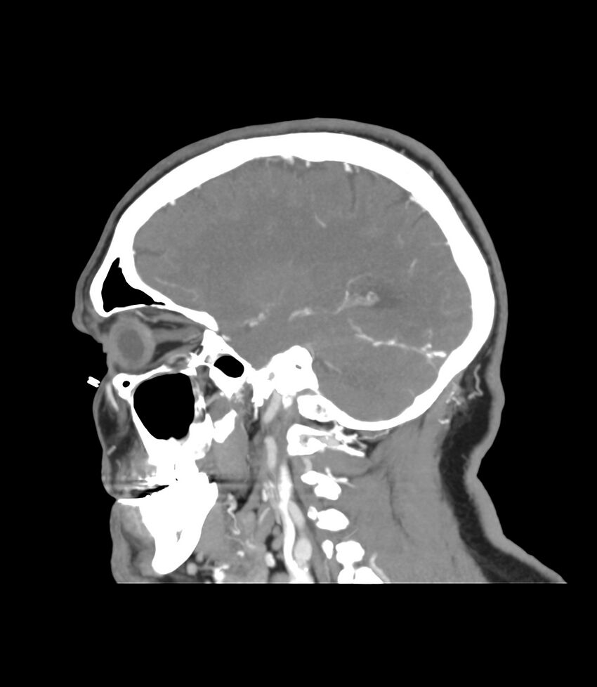 Cerebral dural venous sinus thrombosis (Radiopaedia 86514-102576 C 41).jpg