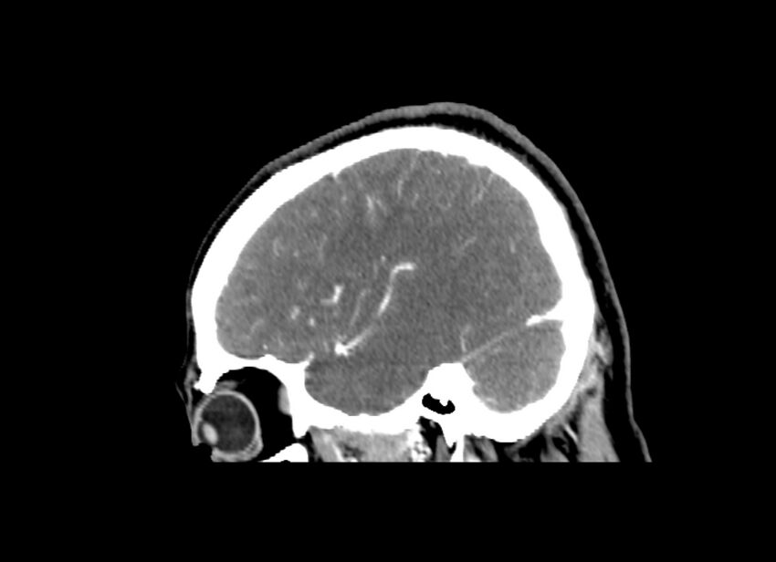 Cerebral edema (Radiopaedia 82519-96661 D 15).jpg