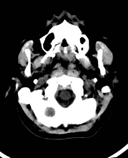 File:Cerebral edema due to severe hyponatremia (Radiopaedia 89826-106938 Axial non-contrast 11).jpg