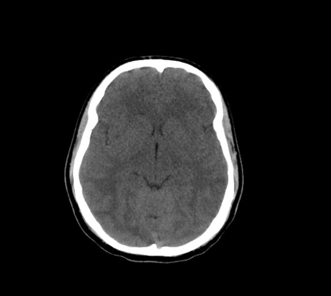File:Cerebral fat embolism (Radiopaedia 37510-39362 Axial non-contrast 16).jpg