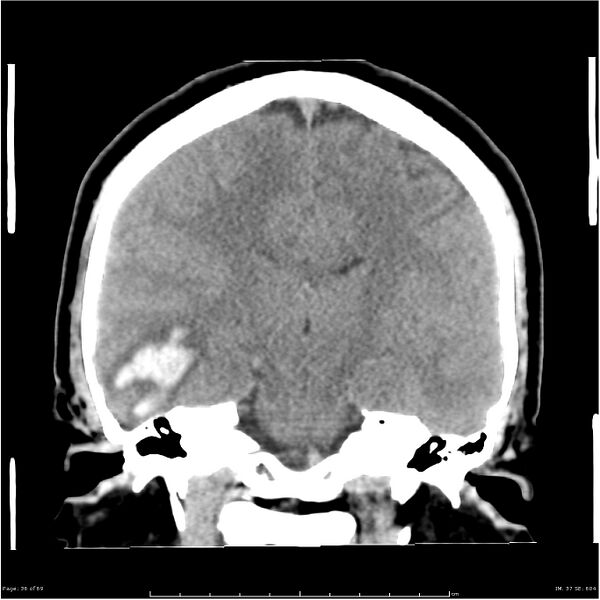 File:Cerebral hemorrhage secondary to arteriovenous malformation (Radiopaedia 33497-34561 Coronal non-contrast 27).jpg