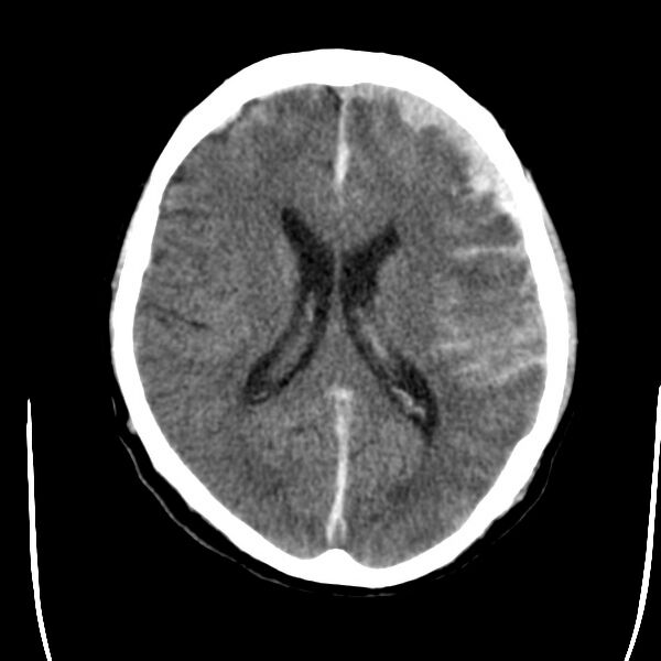 File:Cerebral hemorrhagic contusions (Radiopaedia 23145-23188 Axial non-contrast 23).jpg