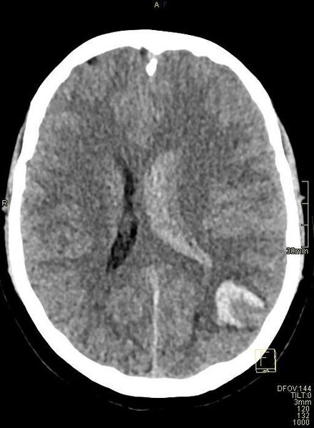 File:Cerebral venous sinus thrombosis (Radiopaedia 91329-108965 Axial non-contrast 30).jpg
