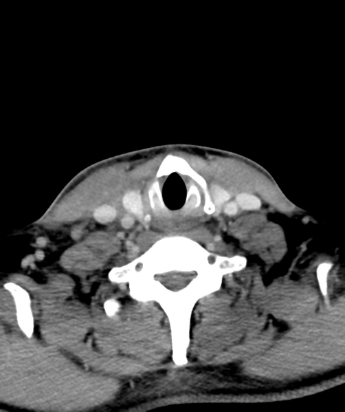 File:Cervical abscess (Radiopaedia 43725-47184 A 51).png