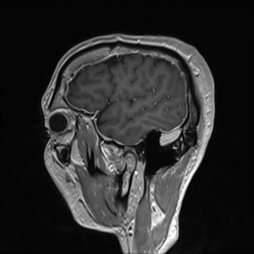 Cervical dural CSF leak on MRI and CT treated by blood patch (Radiopaedia 49748-54995 G 7).jpg