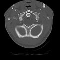 Cervical flexion teardrop fracture with cord hemorrhage (Radiopaedia 32497-33454 Axial bone window 14).jpg
